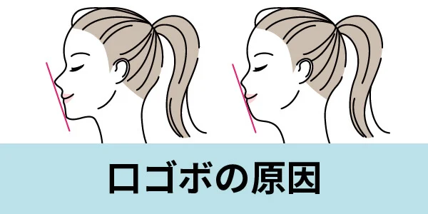 kuchigobo-1 - ルーチェマウスピース矯正歯科 口コボ 原因