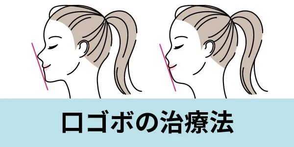 kuchigobo-3 - ルーチェマウスピース矯正歯科 口ゴボ 治療法