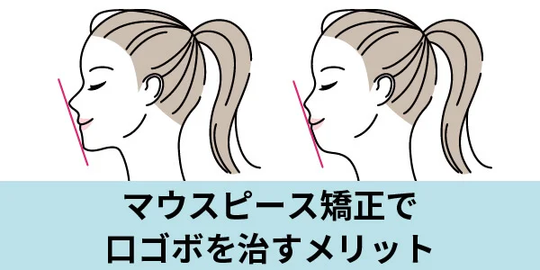 kuchigobo-5 - ルーチェマウスピース矯正歯科 口コボ マウスピース矯正