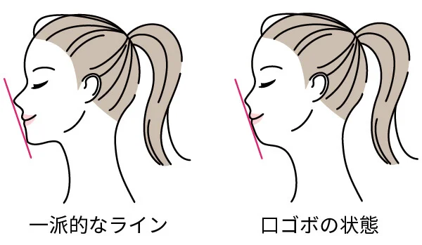 kuichi-gobo - ルーチェマウスピース矯正歯科 口ゴボ 一般 比較