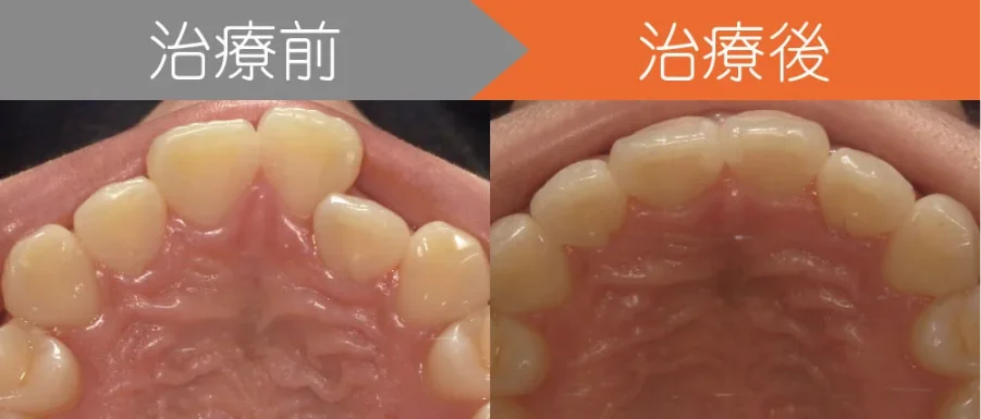 前歯のクロスバイトでお悩みの方をインビザラインで治療した例
