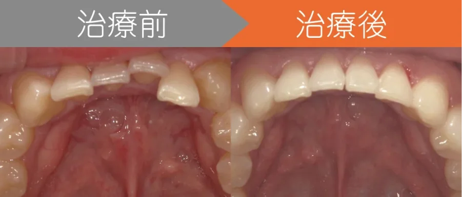 上下の前歯がガタつき、出っ歯でお悩みの方のインビザライン治療例
