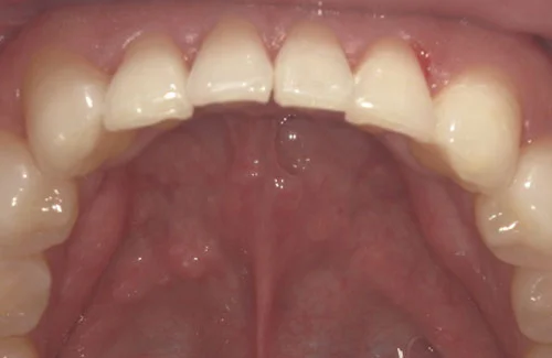 治療後前歯がきれいに揃いました