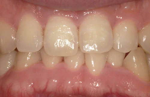 治療前上歯がガタついている