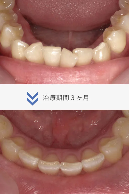 8枚コース/Invisalign アーリー
約3ヶ半月〜4ヶ月
治療費 33万円