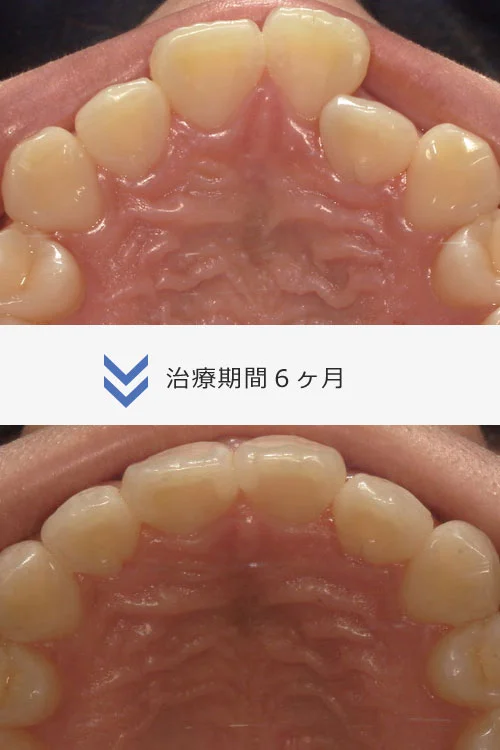 14枚コース/Invisalign ライト
約4ヶ月〜6ヶ月
治療費 49万5千円