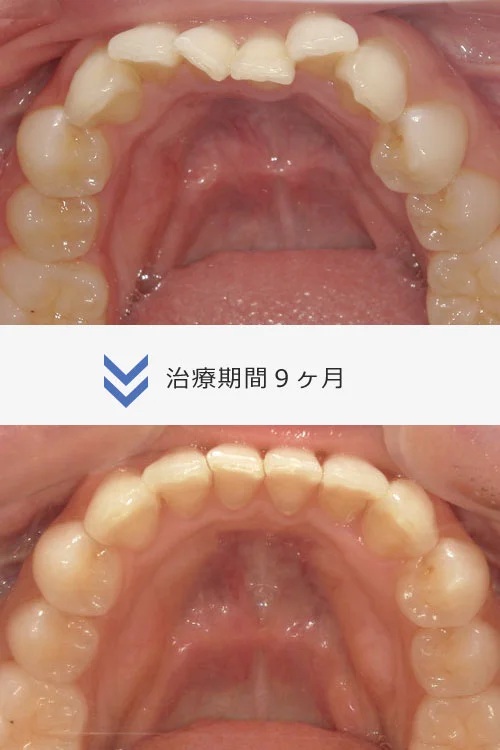 26枚コース/Invisalign モデレート
約6ヶ月〜9ヶ月
治療費 66万円