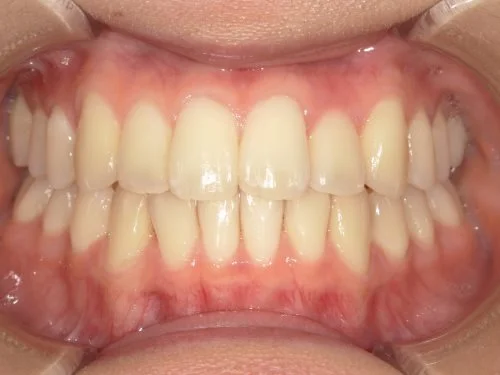 治療後前歯上顎側
