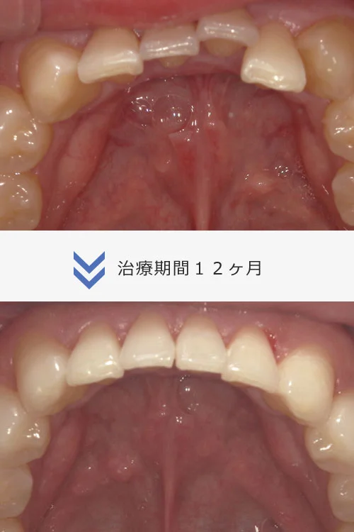 Invisalign フル1プラン
9ヶ月〜1年3ヶ月
治療費 88万円