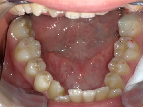 治療前前歯下顎