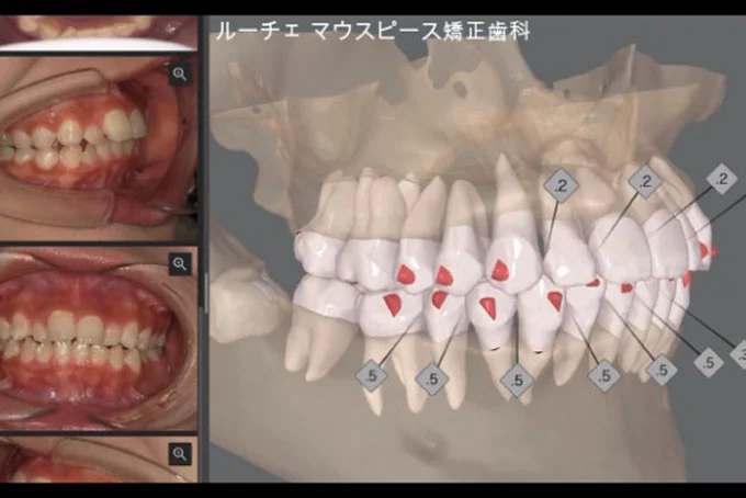 ⑤矯正治療計画を作成