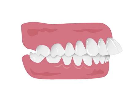 出っ歯（上顎前突）