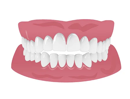 上下の歯が噛み合わない（開咬）