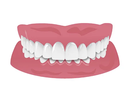 上の歯が下の歯を覆う（過蓋咬合）