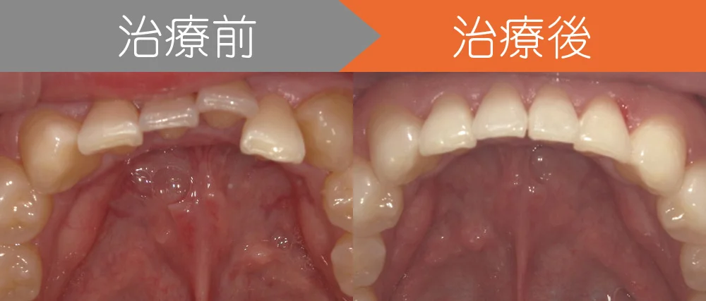 ＜症例１＞上下の前歯がガタつき、出っ歯でお悩み