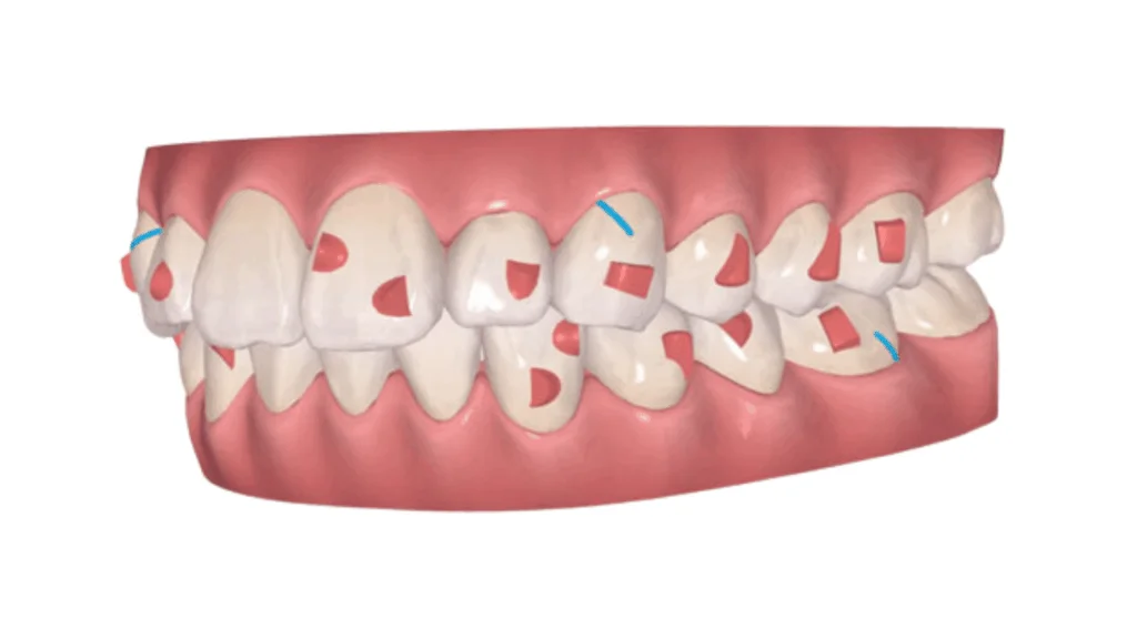 アタッチメント