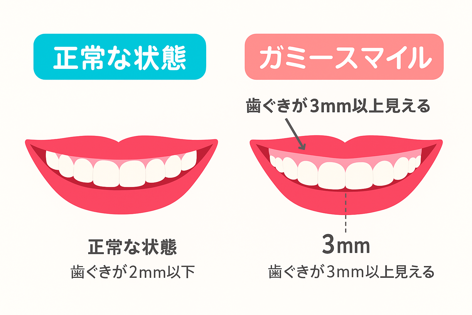 正常な歯肉とガミースマイルの違い