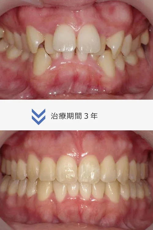 image - ルーチェマウスピース矯正歯科 重度の歯並びの異常