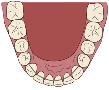 image - ルーチェマウスピース矯正歯科 固定式のリテーナー