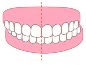 交叉咬合（こうさこうごう）