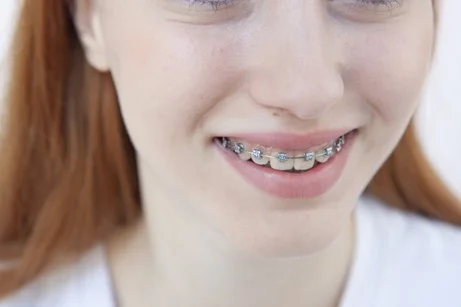 ワイヤー矯正が向かないケース