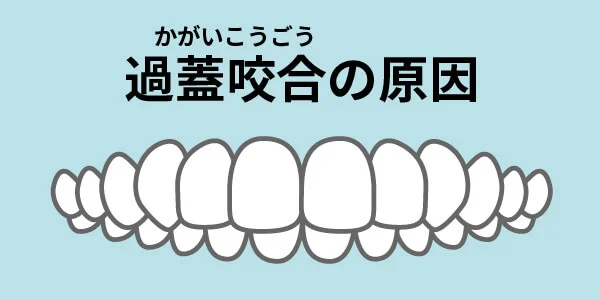 過蓋咬合　原因