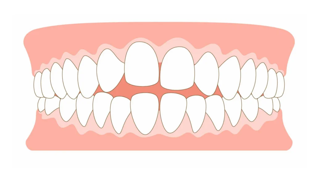 開咬　イメージ画像