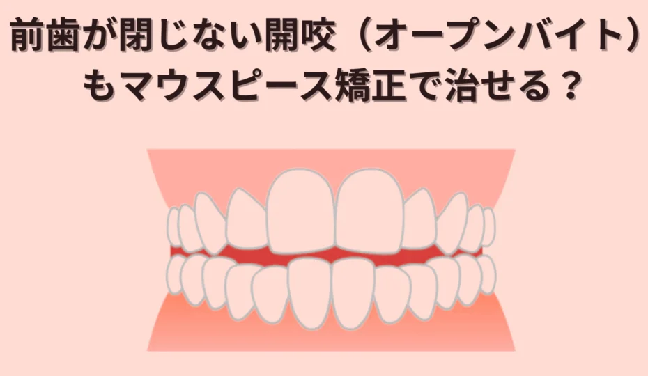 前歯が閉じない開咬（オープンバイト）もマウスピース矯正で治せる？ アイキャッチ